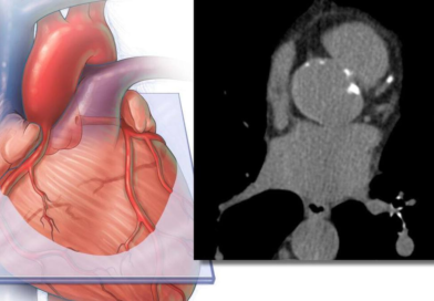 Incluir la medición de grasa cardíaca derivada de IA mejora la precisión en la predicción del riesgo de enfermedad cardiovascular