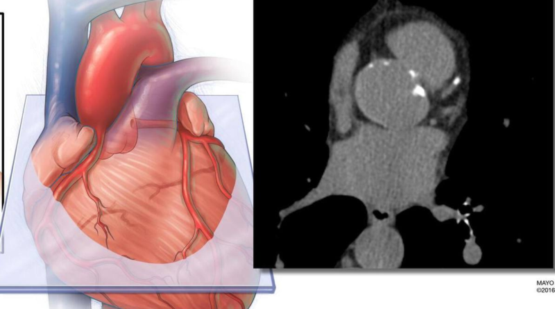 Incluir la medición de grasa cardíaca derivada de IA mejora la precisión en la predicción del riesgo de enfermedad cardiovascular