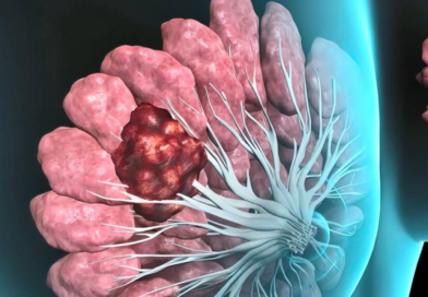 Cáncer de mama inflamatorio: Una forma de rápida evolución que a menudo no presenta un bulto como señal de alarma  Octubre e