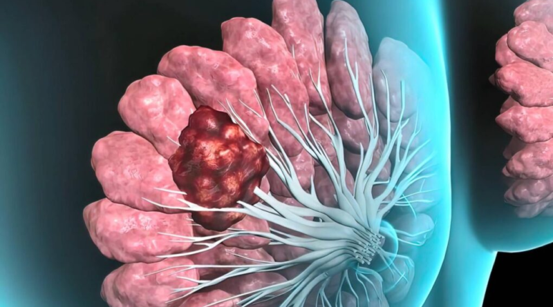 Cáncer de mama inflamatorio: Una forma de rápida evolución que a menudo no presenta un bulto como señal de alarma  Octubre e